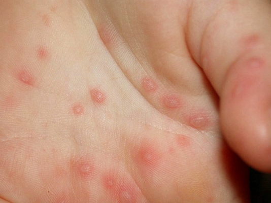 红疹的症状和治疗图片