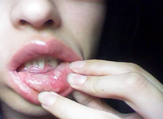 嘴唇唇炎症状图片图片