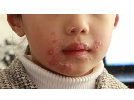儿童唇炎的症状有哪些图片