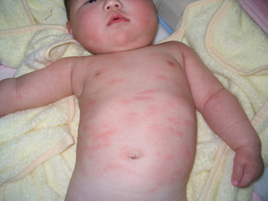 小孩麻疹图片 (2)