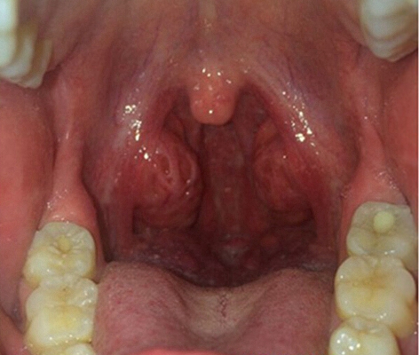 喉咙长了个囊肿图片 (50)