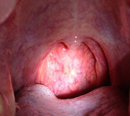 喉咙长了个囊肿图片 (59)