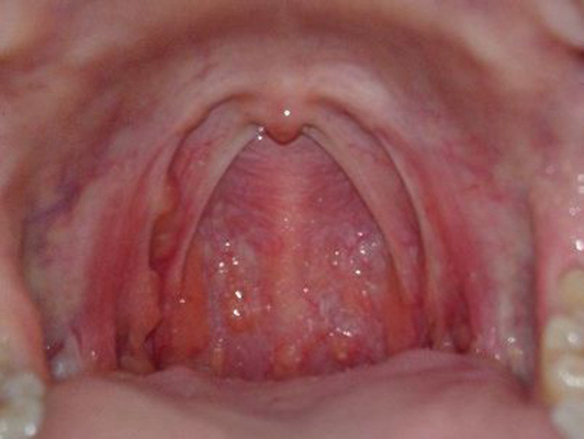 喉咙长了个囊肿图片 (61)