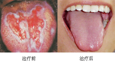 口腔内壁扁平苔藓图片