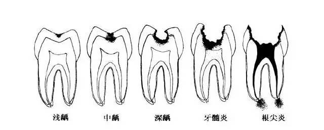 牙齿洞型分类及图片图片