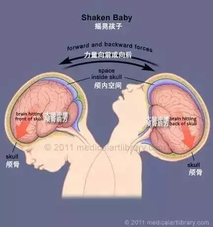 小儿脑瘫预防有哪些有效的措施?