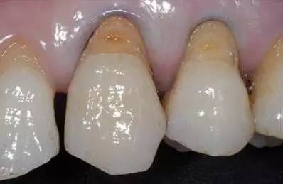 这几张图片,带你认识什么是牙齿的楔状缺损楔状缺损的树脂充填 文伟