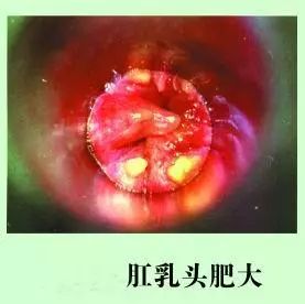 肛门异物感是怎么回事