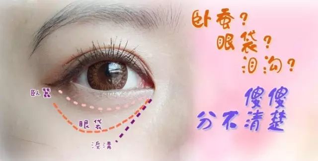 祛除泪沟常见方法有哪些?