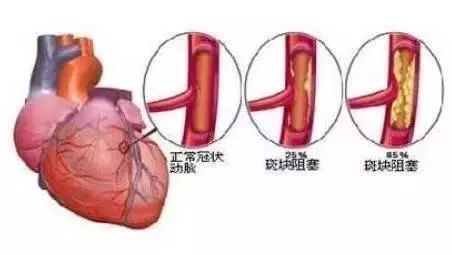 什麼是冠脈狹窄?中醫怎麼治療?