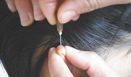 网传急救脑卒中方法显示:卒中(不管脑出血还是栓塞),口眼歪斜