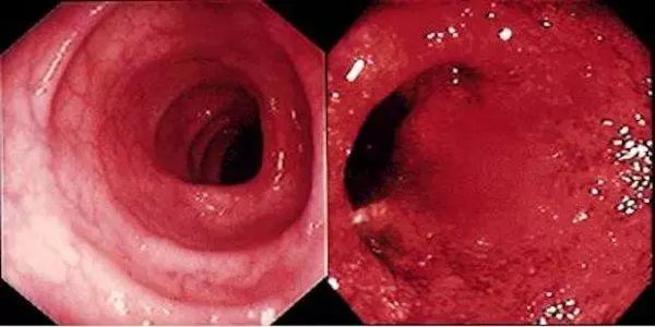 溃疡性结肠炎会影响寿命吗