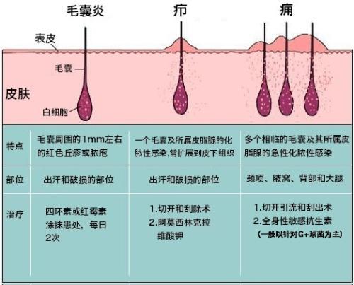 5,皮脂腺囊肿是导管堵塞,皮脂腺分泌物排出不畅引起的内容物堆积.