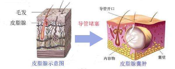 痈的图片区别图片