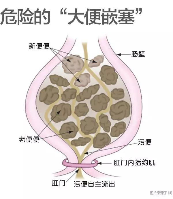 肛肠手术后到底该不该用止痛药?