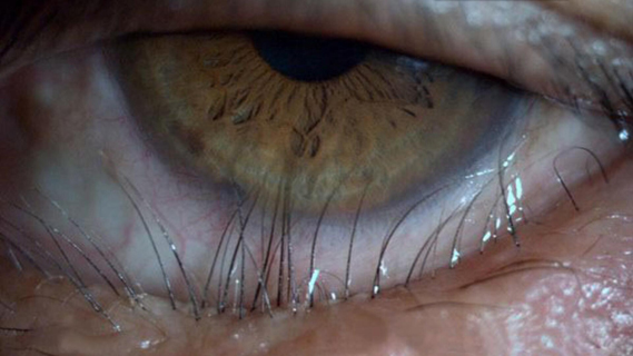 倒睫可以不手术吗