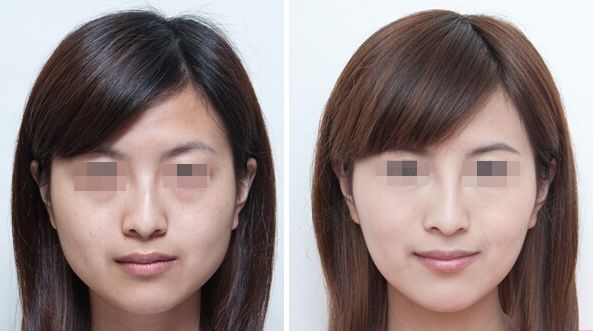 瘦脸针和水光针同时打要注意什么