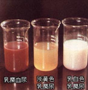 磷酸盐尿图片