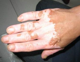 注意补充微量元素