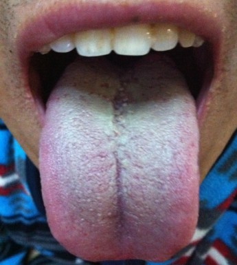 舌苔胖大有齿痕,是身体的什么信号?