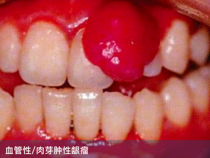 血管性:肉芽肿性龈瘤