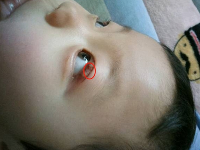 霰粒肿小孩眼皮出现多个红色的小疙瘩图.jpg