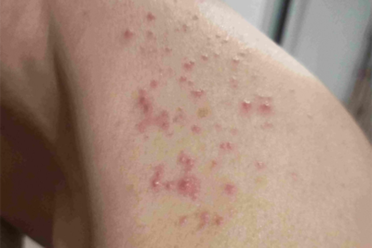 体虱病肩部丘疹图 体虱病肩部丘疹图
