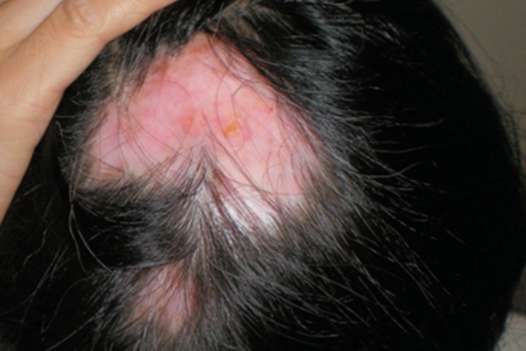 盘状红斑狼疮头皮症状图