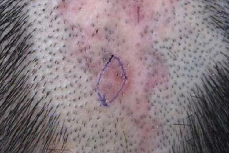 扁平苔藓头皮脱发长红斑图