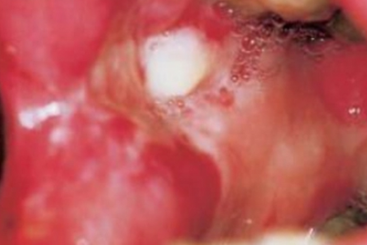 一期梅毒喉咙硬下疳图