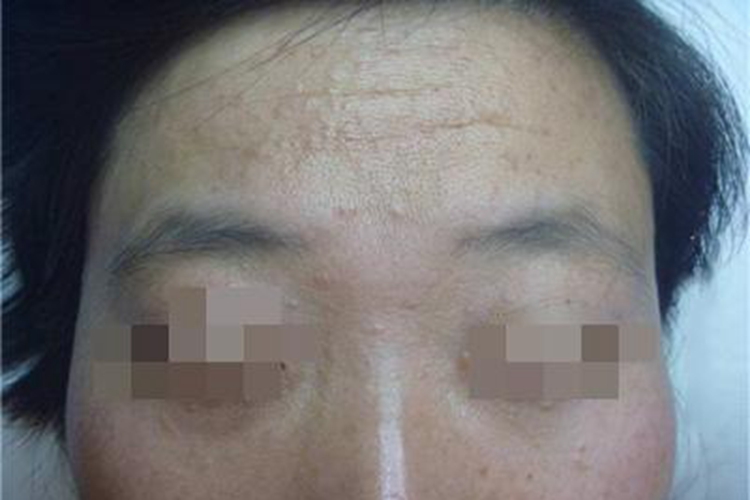 汗管瘤前额密集凸起的丘疹图 汗管瘤前额密集凸起的丘疹图