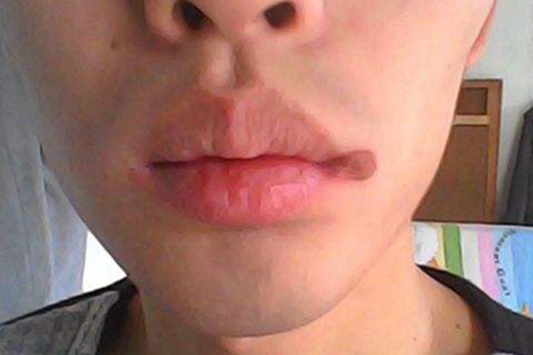 感染性口角炎图