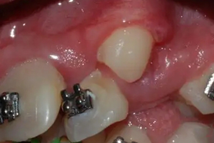 阻生牙尖牙在牙龈上图