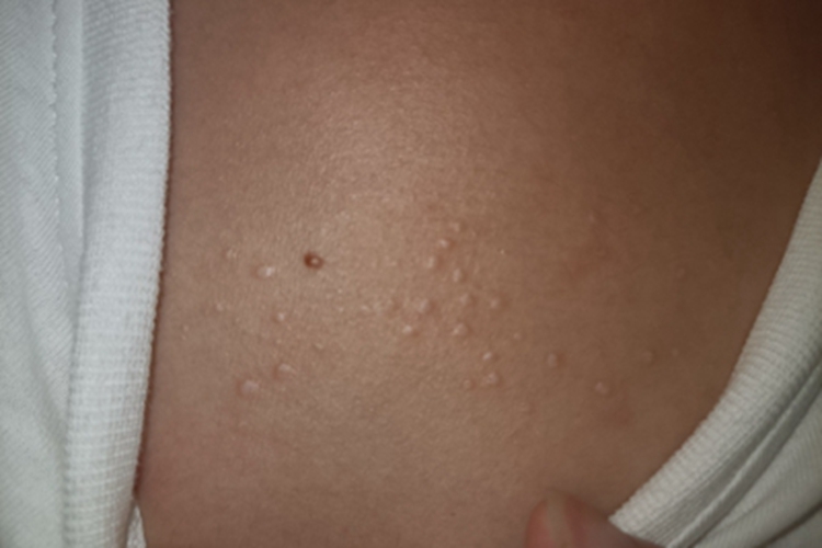 皮脂腺增生胸部症状图 皮脂腺增生胸部症状图