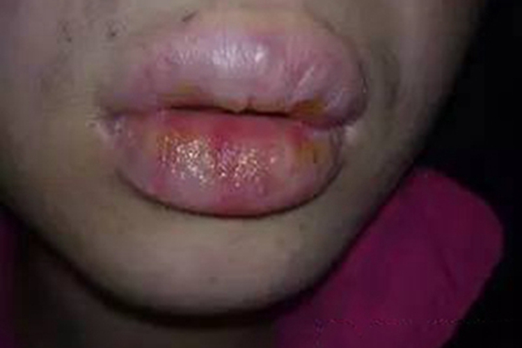 肉芽肿性唇炎嘴唇渗液图