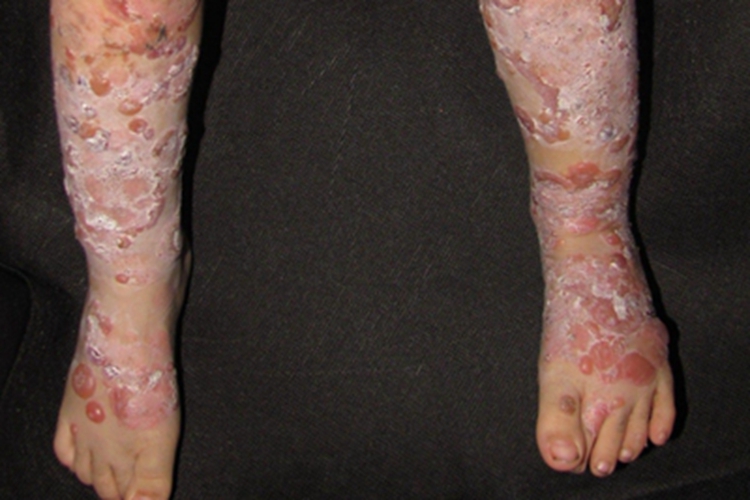 线状IgA大疱性皮肤病腿水疱图