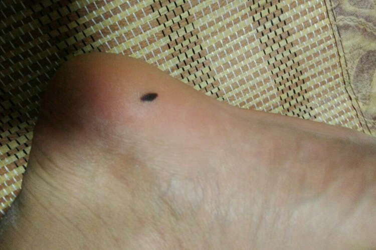 脚后跟黑痣图