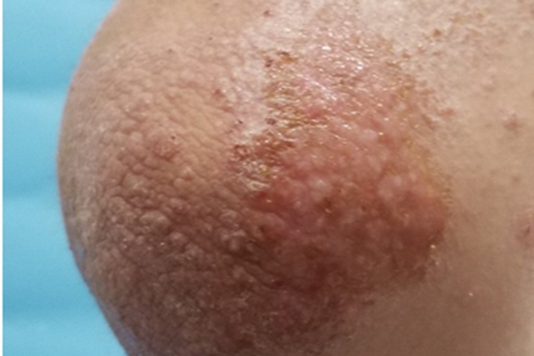 青年成人期特应性皮炎肘部结痂图