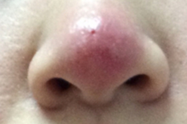 鼻赘型酒糟鼻鼻尖症状图