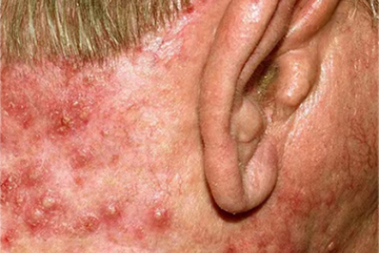 细菌性毛囊炎侧颈脓包图