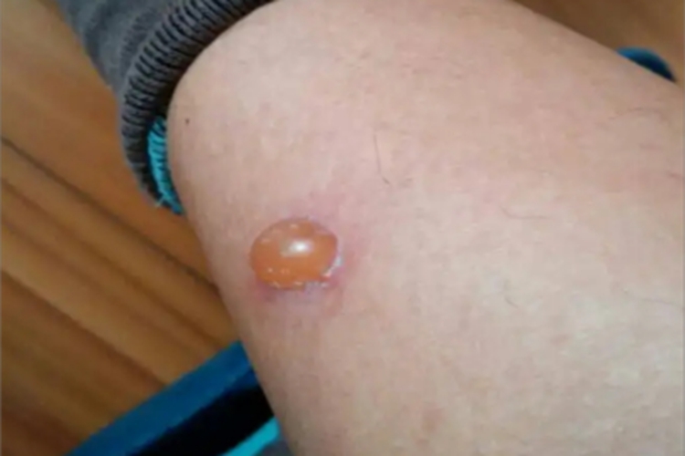 脓疱疮小腿症状图 脓疱疮小腿症状图