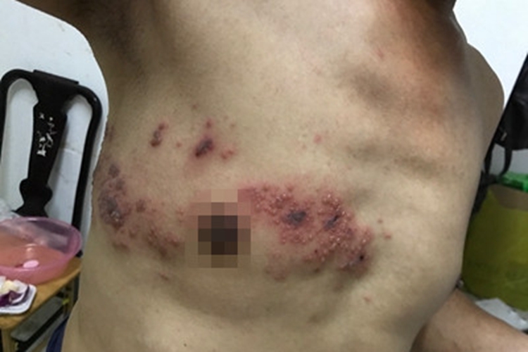 带状疱疹胸部症状图