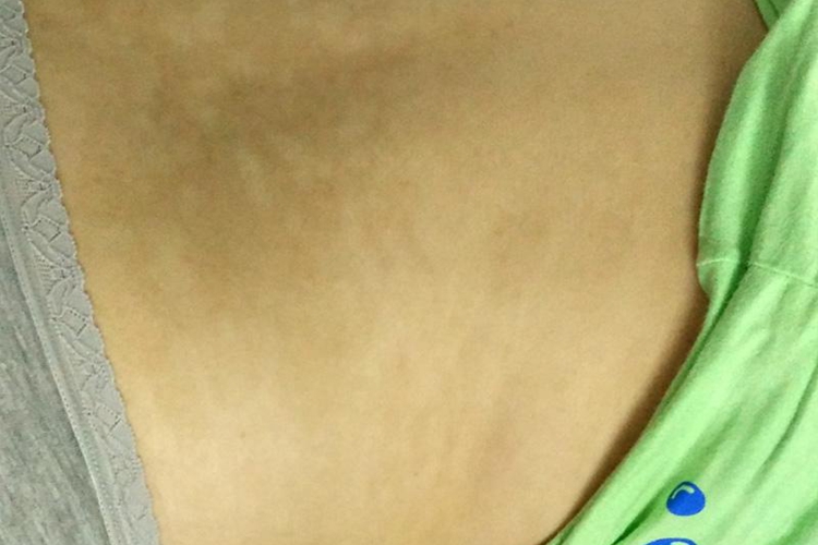 摩擦黑变病女性后腰皮肤发黑图