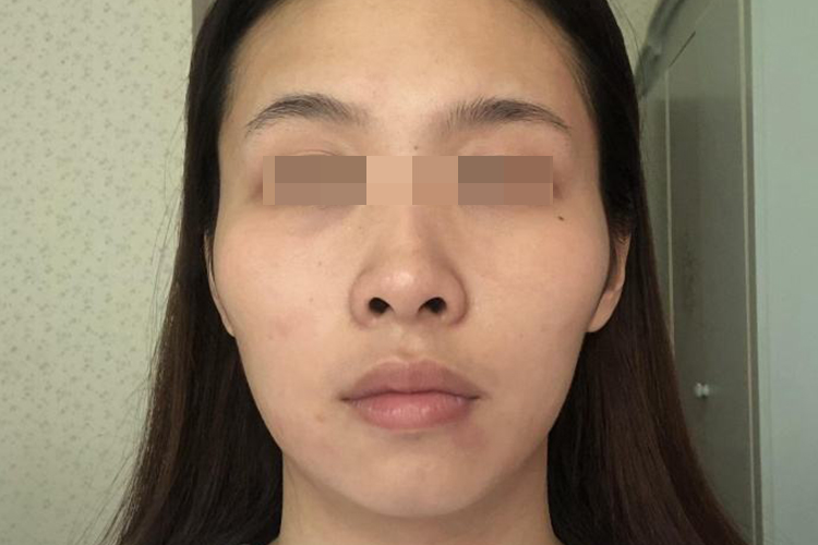 脸部颧骨下方凹陷图