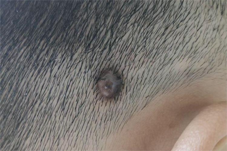 头上寻常疣图 头上寻常疣图