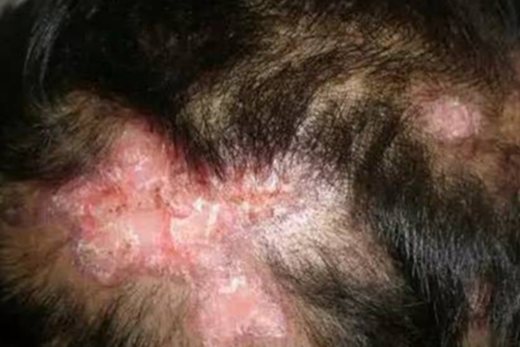 盘状红斑狼疮脱屑图