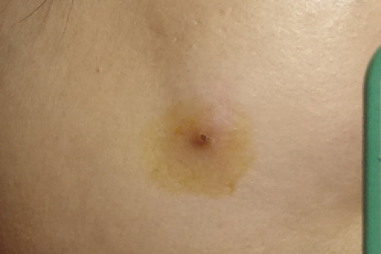 皮脂腺囊肿图 皮脂腺囊肿图