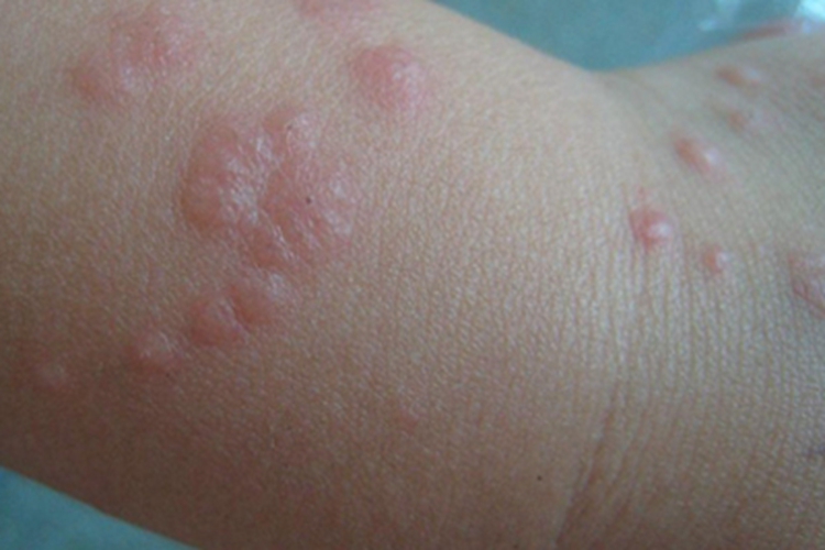恙螨皮炎手腕小红疙瘩图 恙螨皮炎手腕小红疙瘩图