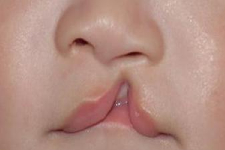 儿童Ⅱ度唇裂图 儿童Ⅱ度唇裂图