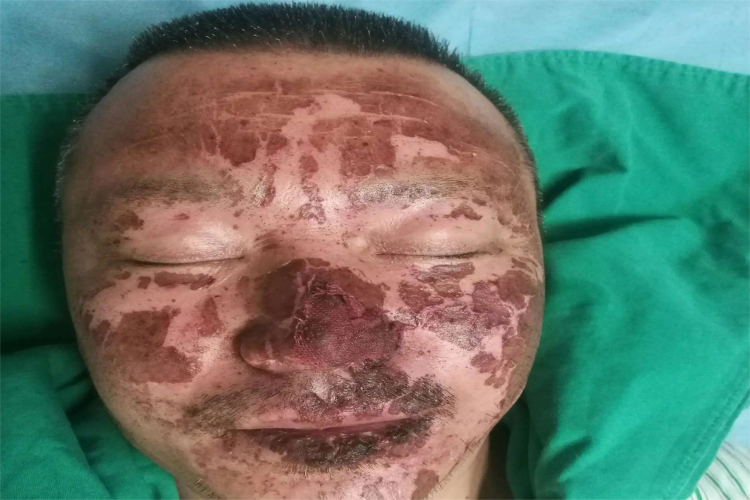 电弧烧伤面部脱皮图